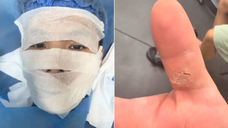 健身室衞生防範：廣東男子運動後擦汗致面部真菌感染，專家提供防護建議