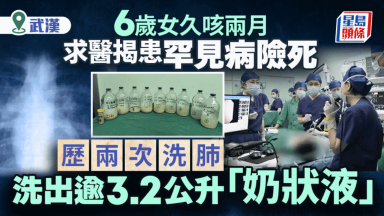六歲女童久咳兩月 確診罕見肺泡蛋白沉積症 雙肺灌洗出逾三公升沉積物