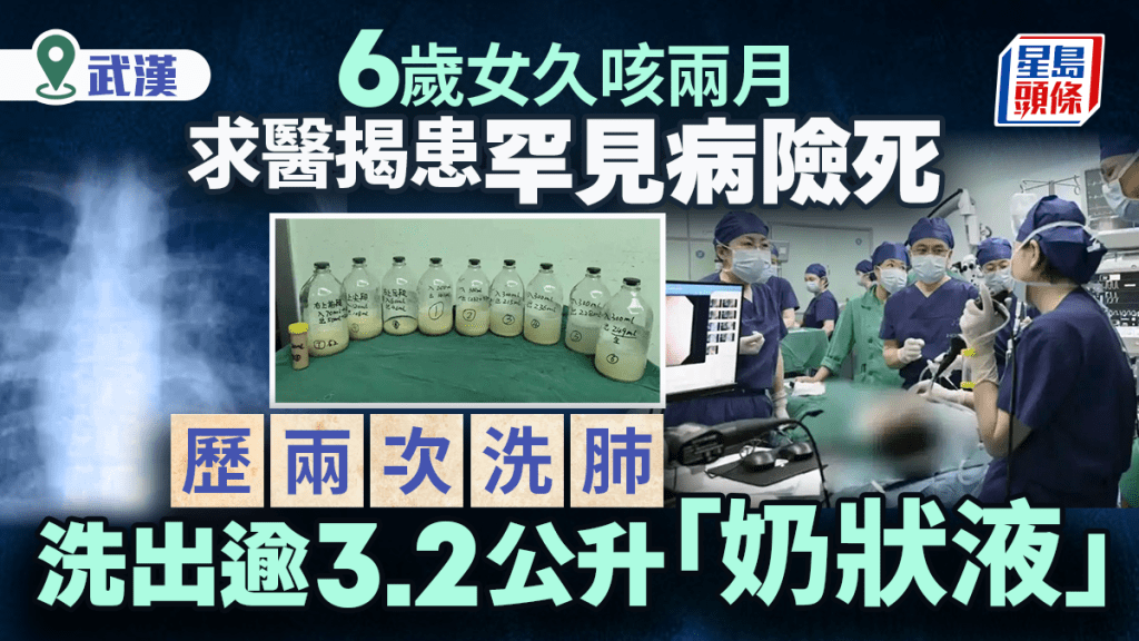 六歲女童久咳兩月 確診罕見肺泡蛋白沉積症 雙肺灌洗出逾三公升沉積物