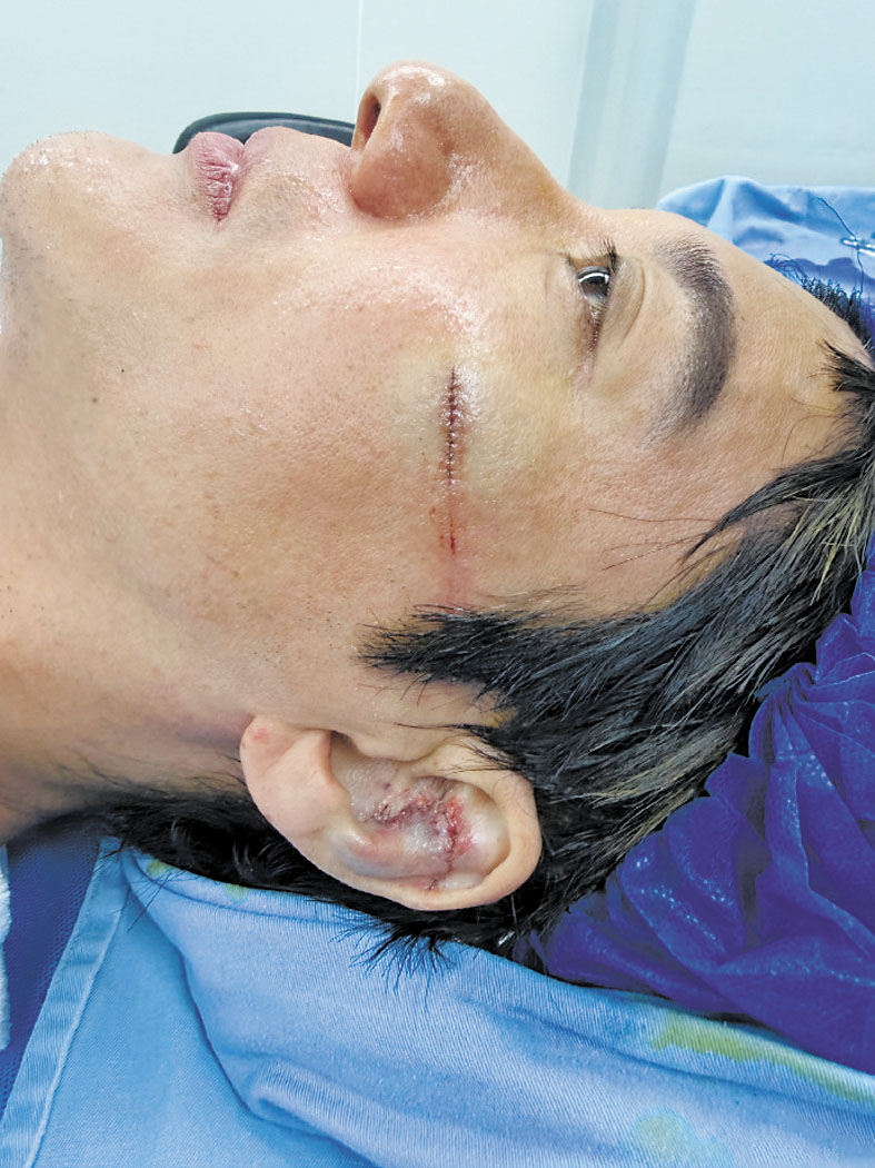 王力宏臉部和耳朵縫了39針。網上圖片