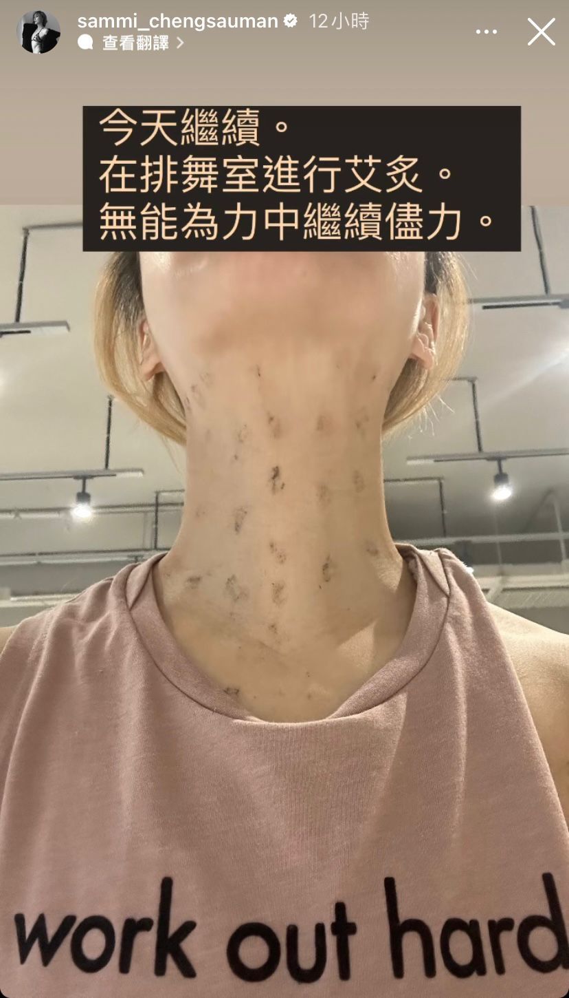 她在排舞室進行艾灸治療。