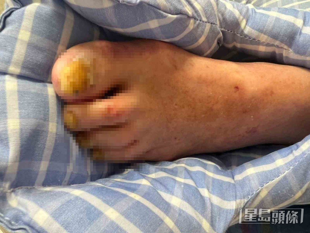 方俊日前回港後到護老院探望，發現張偉文雙腳出現紅腫、瘀黑及皮膚潰爛的情況。
