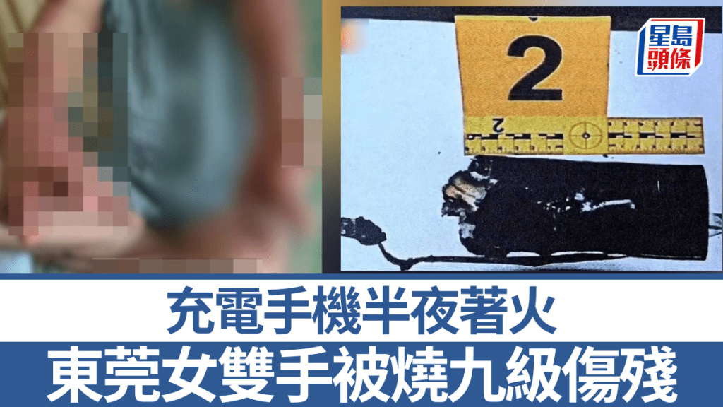 東莞女子邊充電邊用手機後入睡 手機起火致嚴重燒傷