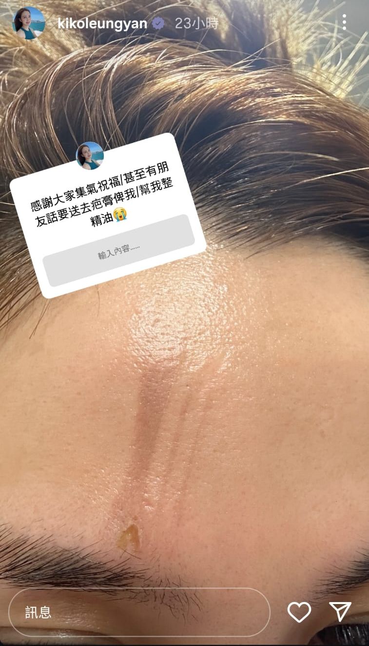 梁茵去年曾在 IG 透露不慎被電髮棒燙傷額頭。