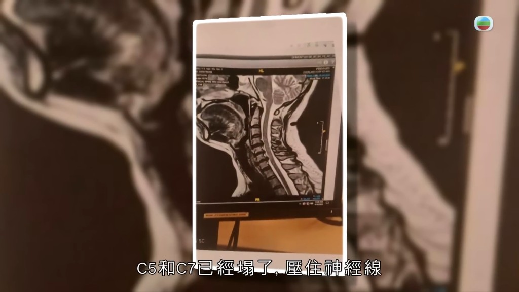陳秀茹的頸椎(C4、C5、C7及T1)壓住了神經線。