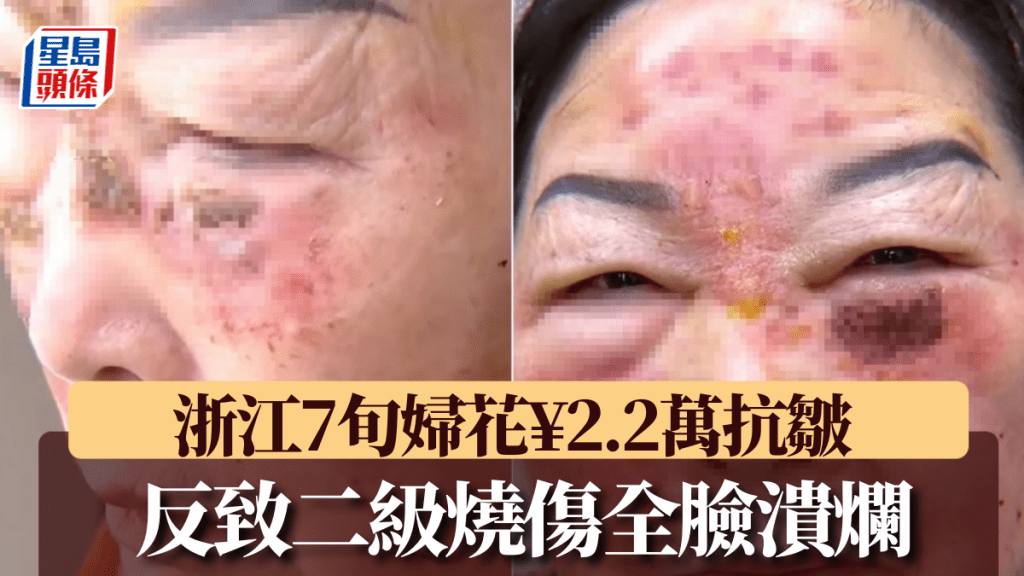 浙江七旬婦接受醫美抗皺療程後面部二度燒傷 家屬質疑診所違規操作