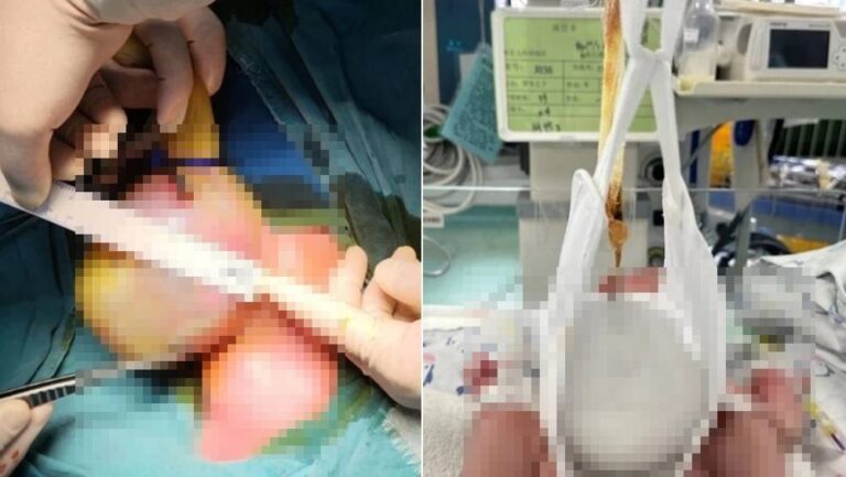 武漢醫療團隊以創新「懸吊法」成功救治罕見「先天性巨大臍膨出」男嬰