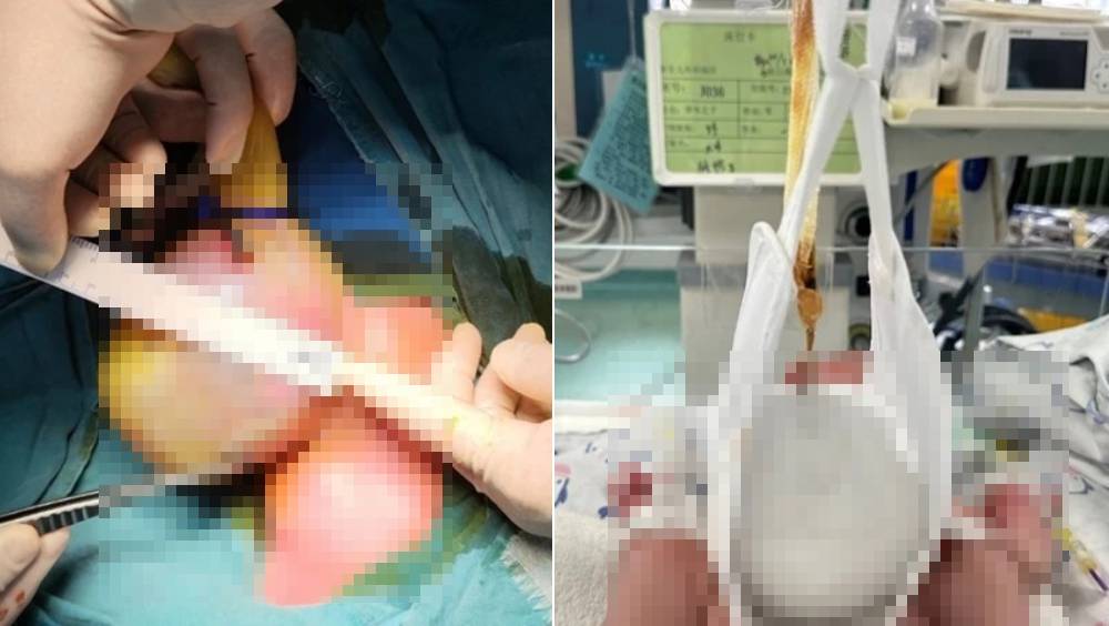 武漢醫療團隊以創新「懸吊法」成功救治罕見「先天性巨大臍膨出」男嬰