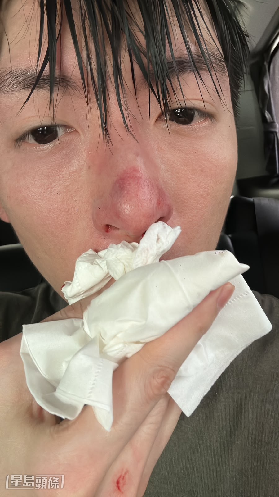 拍攝期間,他不慎被對手演員的重拳擊中鼻子。