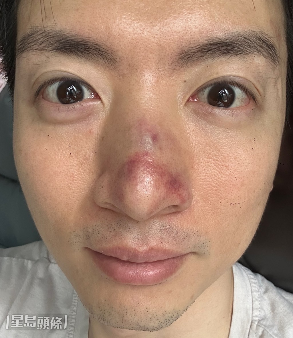他隨即被送院檢查,X光結果證實鼻骨骨折。