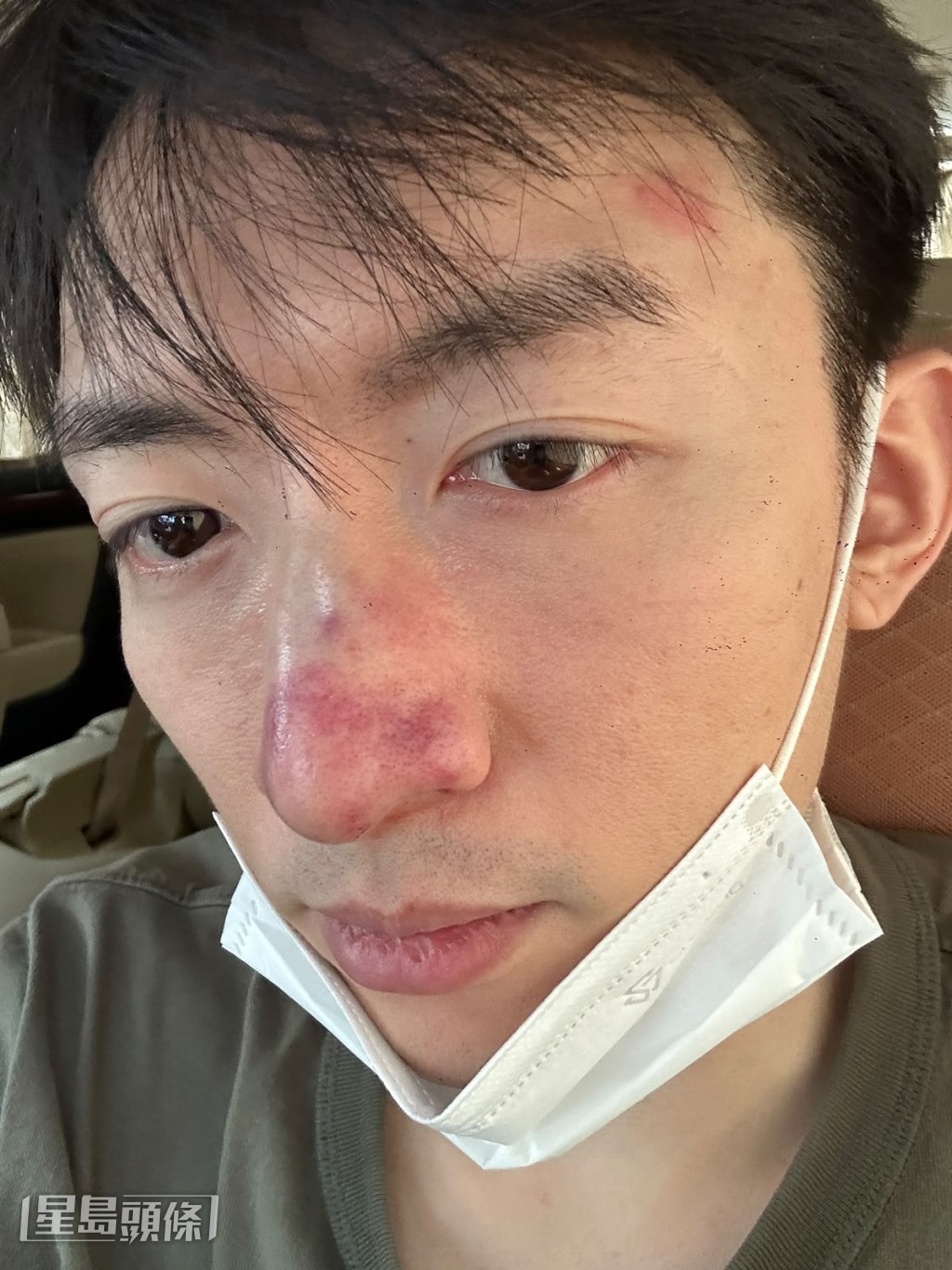 譚坤倫起初以為是小問題,因見過不少前輩演員同樣輕傷不下火線。