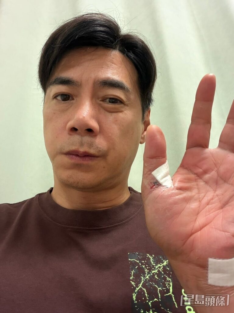 崔錦棠車禍後報平安 手傷影響工作暫休一周