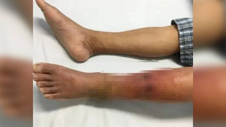 深圳男子因摳腳習慣引發丹毒 醫生解析皮膚感染風險