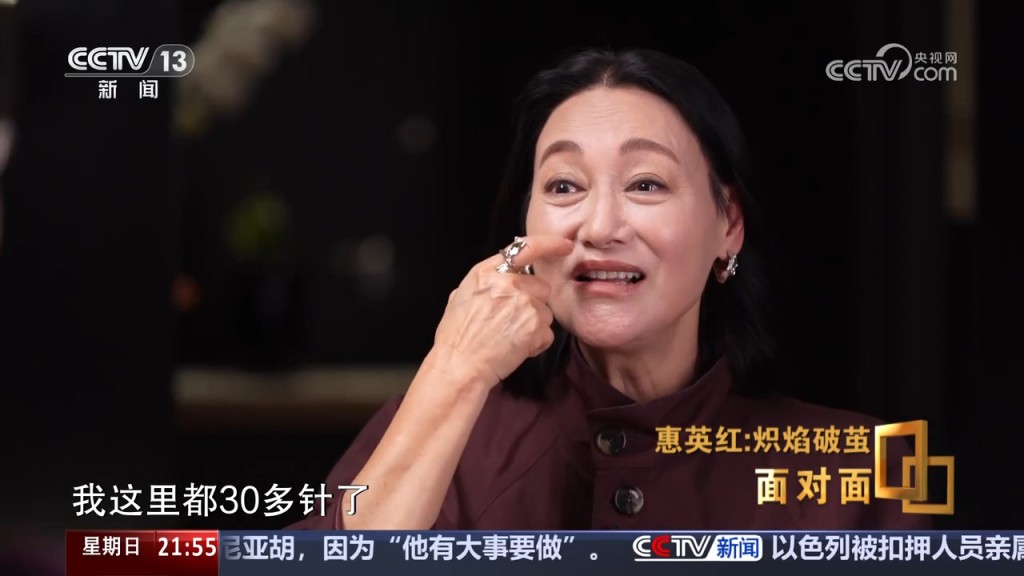 惠英紅曾在其他內地訪問中,透露臉上曾縫過多達89針。