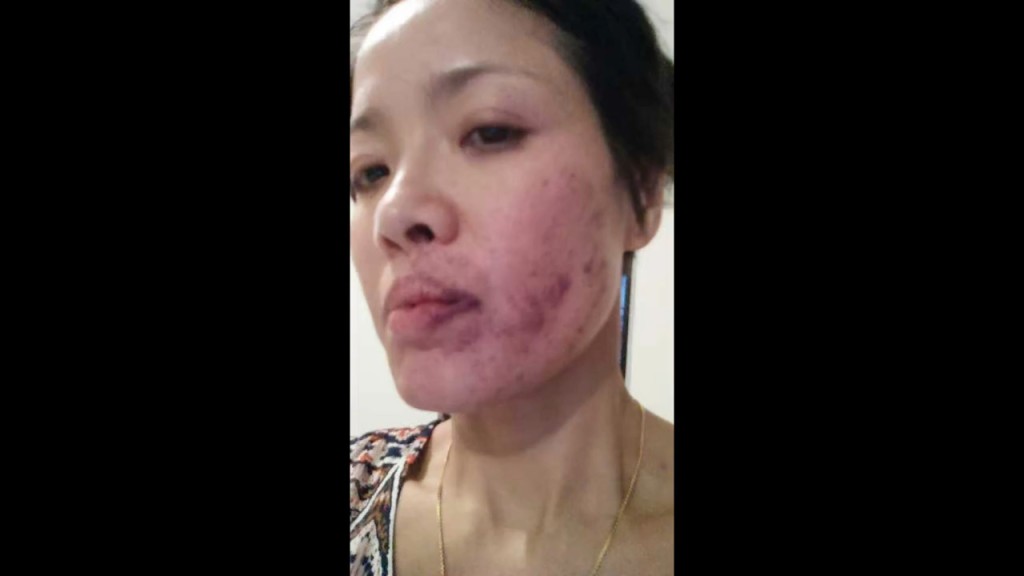 寶珮如提供的舊照展示拍戲被真打後的傷勢，確實紅腫瘀黑一片。
