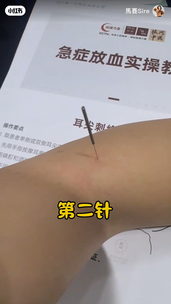 馬賽的第二針是刺在臂彎位置。