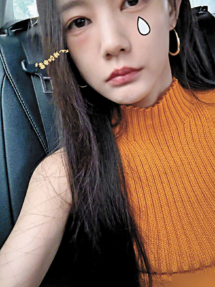 李一桐遭毒蟲咬，左眼下方有一個明顯大包。