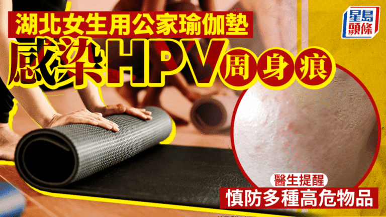 湖北女子使用公用瑜伽墊後感染HPV引發扁平疣 醫生提醒多種公共物品存風險