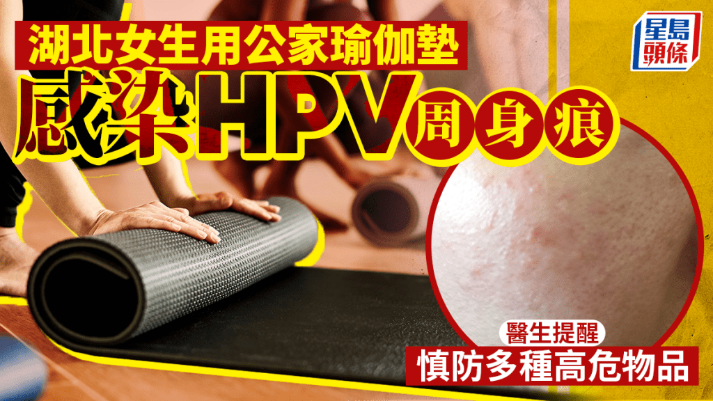 湖北女子使用公用瑜伽墊後感染HPV引發扁平疣 醫生提醒多種公共物品存風險