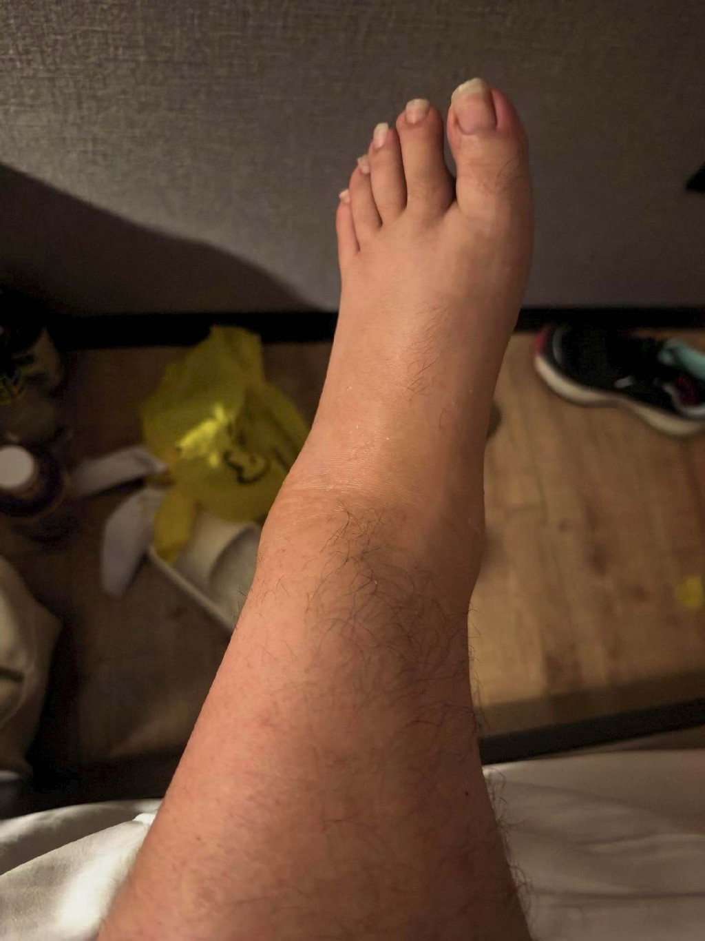 何嘉珍分享腳部包紮照時,不介意展示腿部,盡顯真性情。