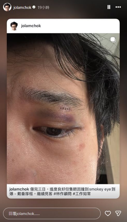 林作透露自己的右眼目前仍然瘀黑。
