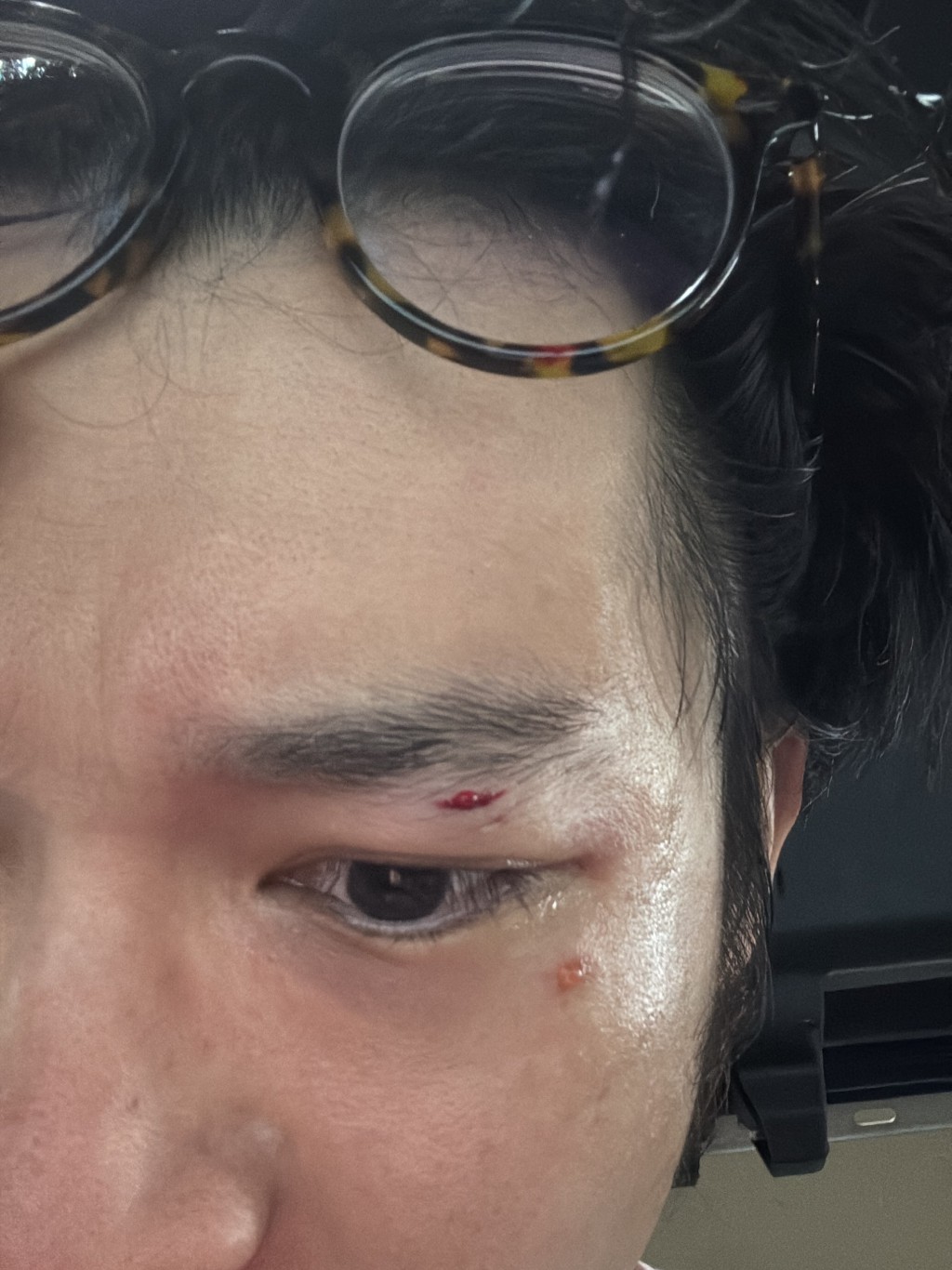 林作在受傷後，仍然不忘自拍記錄情況。