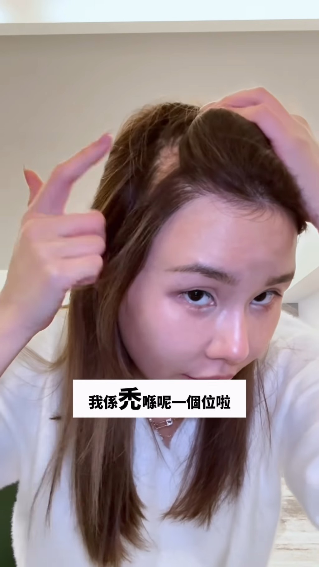 五索公開自己嚴重脫髮的情況。