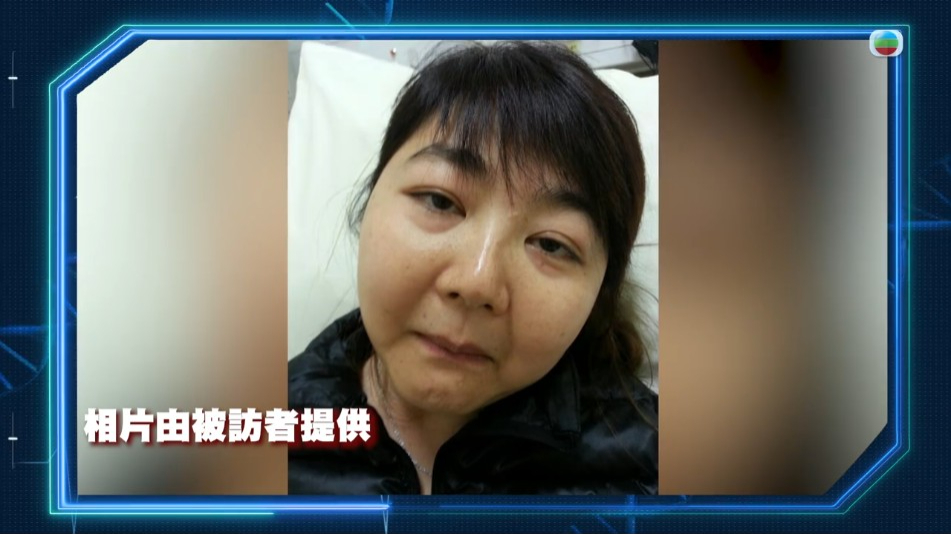陳存正因服用類固醇的影響,臉部變得圓腫(滿月臉)。