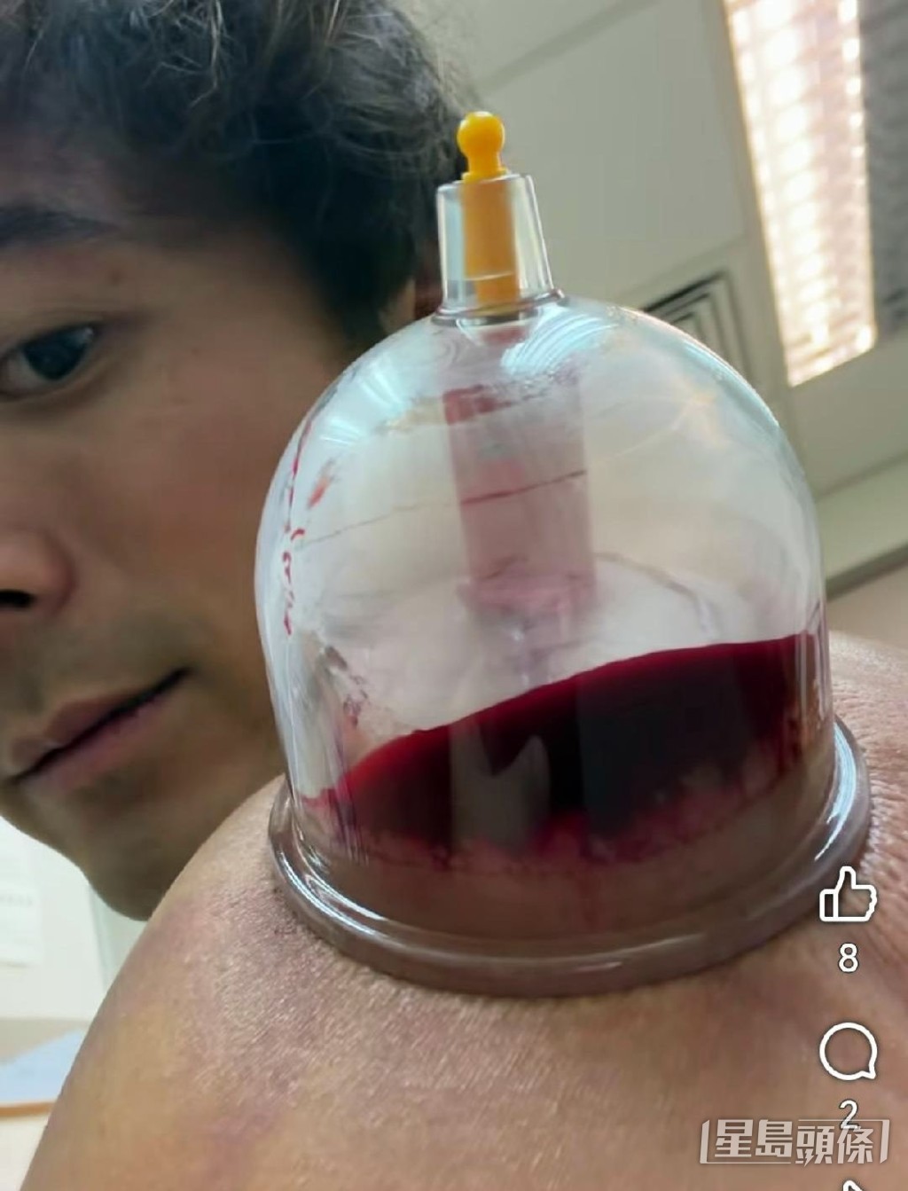 Alex分享治療肩周炎的抽血照片後,收到不少網友查詢治療地點。