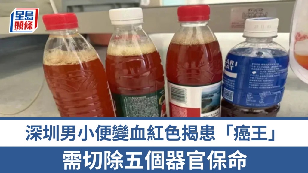 深圳男子小便呈血紅色 確診胰臟癌需接受多器官切除手術