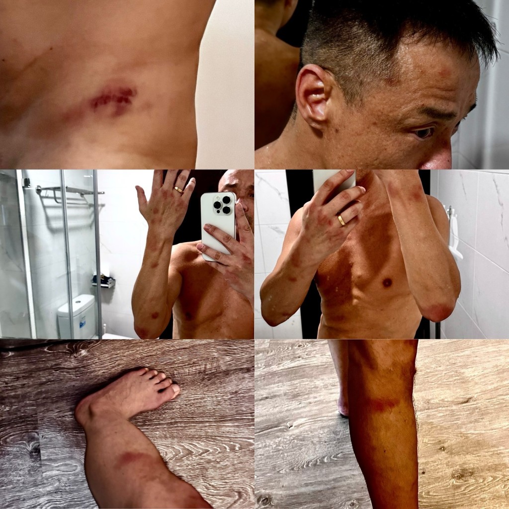 王喜曾在IG上貼出多張身上有傷痕的照片。