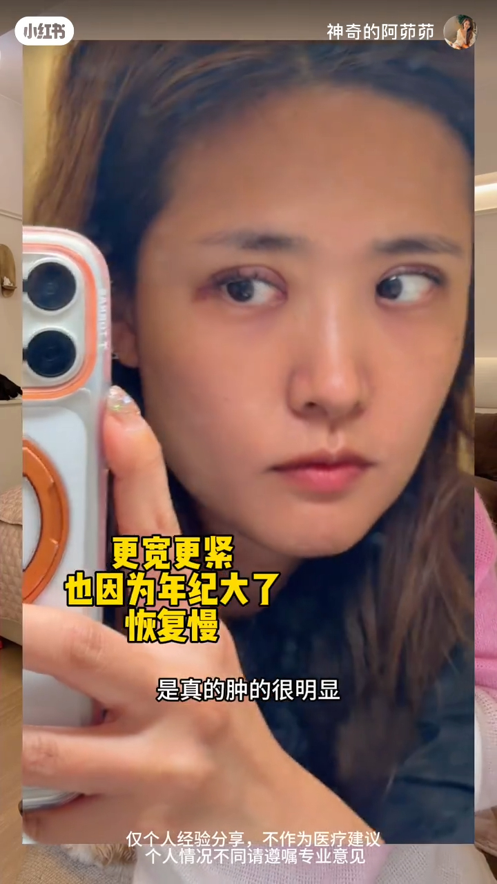 這是張茆手術後數天的恢復過程記錄，眼皮位置依然可見瘀青。