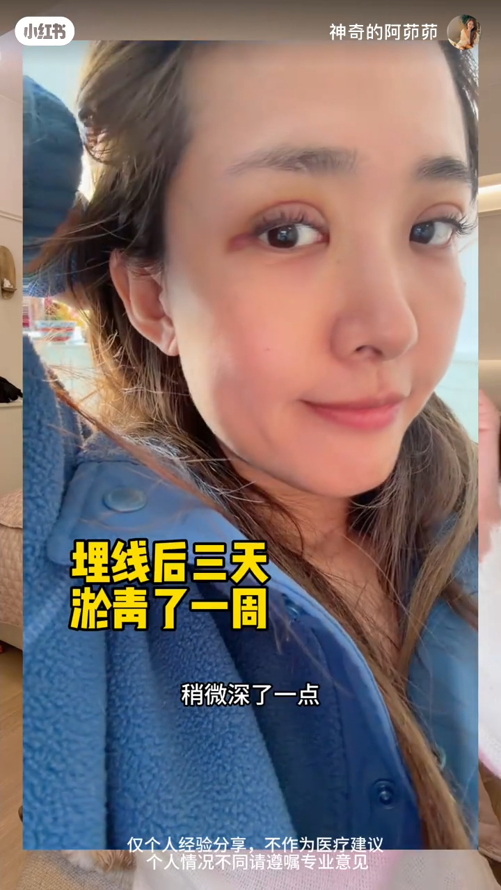 張茆展示了第二次「埋線」手術初期的恢復狀況，眼部可見明顯紅腫和瘀青。