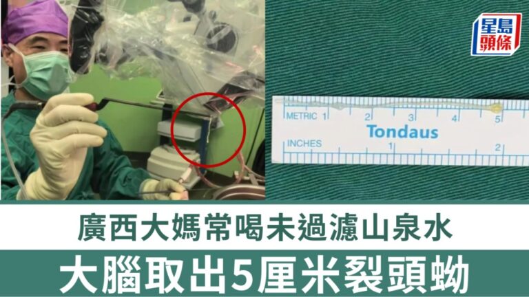 廣西女子長期飲用未過濾山泉水 腦內發現5厘米寄生蟲