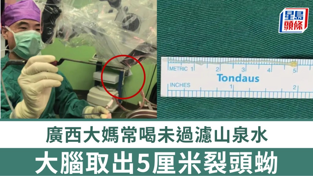 廣西女子長期飲用未過濾山泉水 腦內發現5厘米寄生蟲