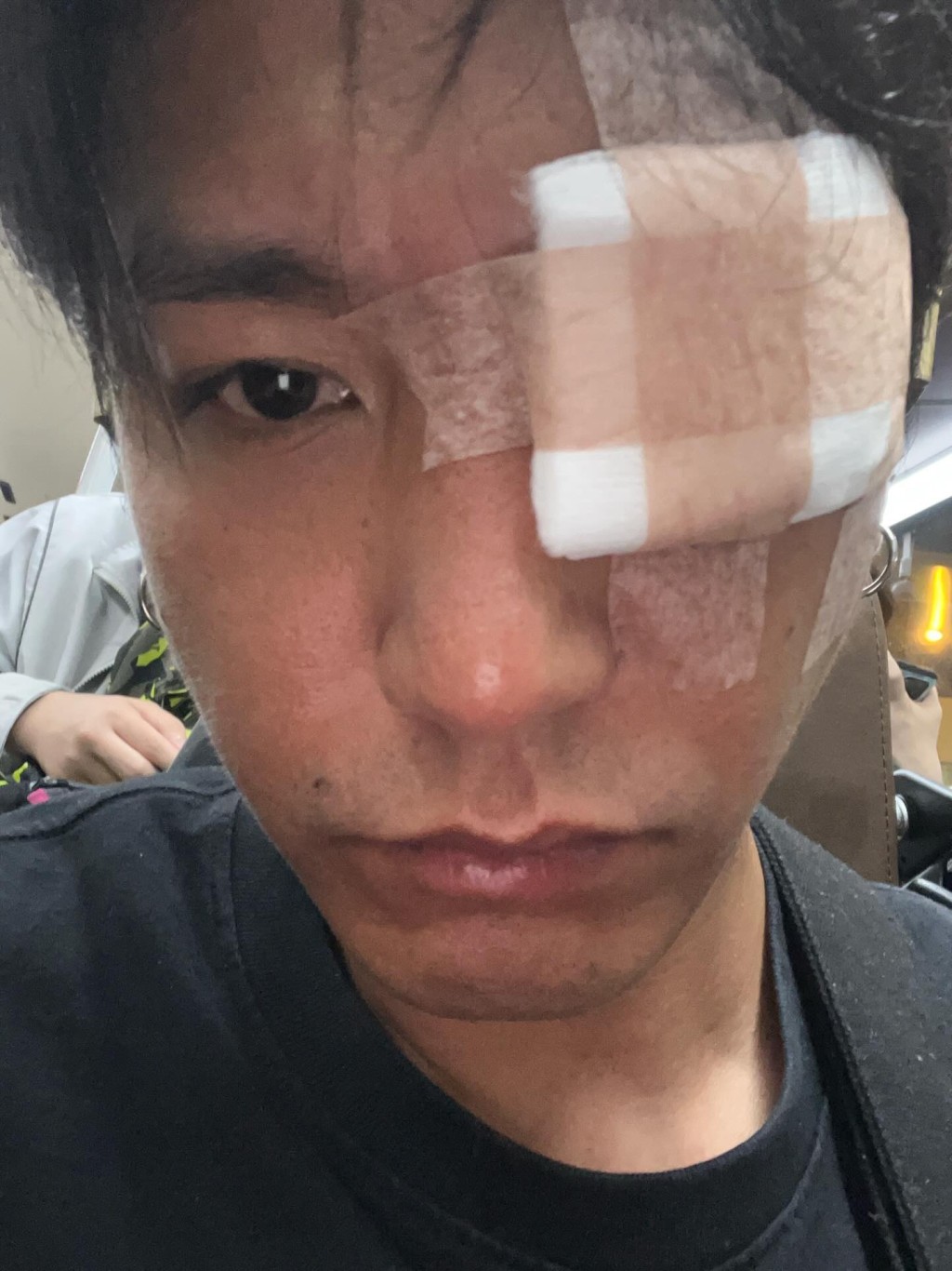 林耀聲早前在Threads貼出術後照片,透露剛完成割眼瘡手術,直言痛楚難忍:「依家連轉一轉個眼球都痛到hihi。」