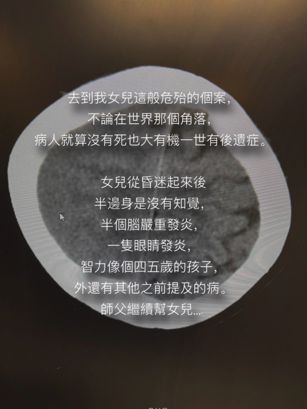 張新悅指此類病人即使存活,亦很大機會有永久後遺症。