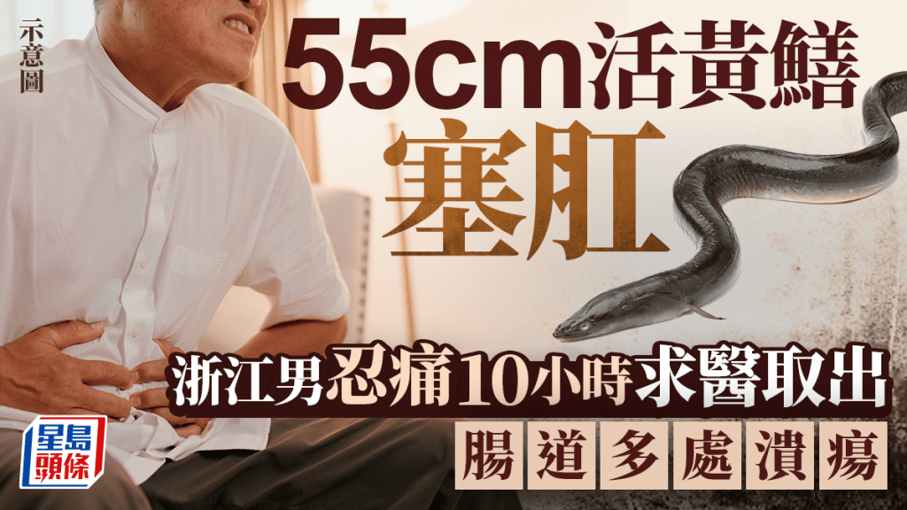浙江男子將活黃鱔塞入直腸 延誤逾10小時始就醫取出