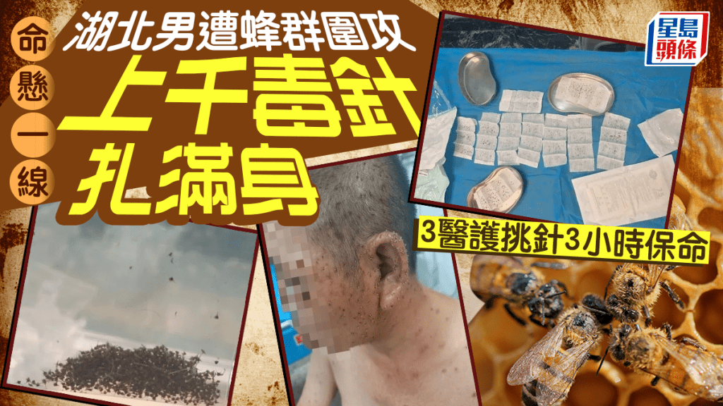 湖北男子遭蜂群襲擊身中近千針 醫護三小時拔刺成功救治
