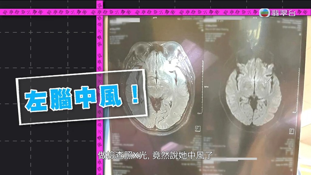 醫院磁力共振檢查證實葉小姐「左腦中風」，導致右側身體癱瘓。