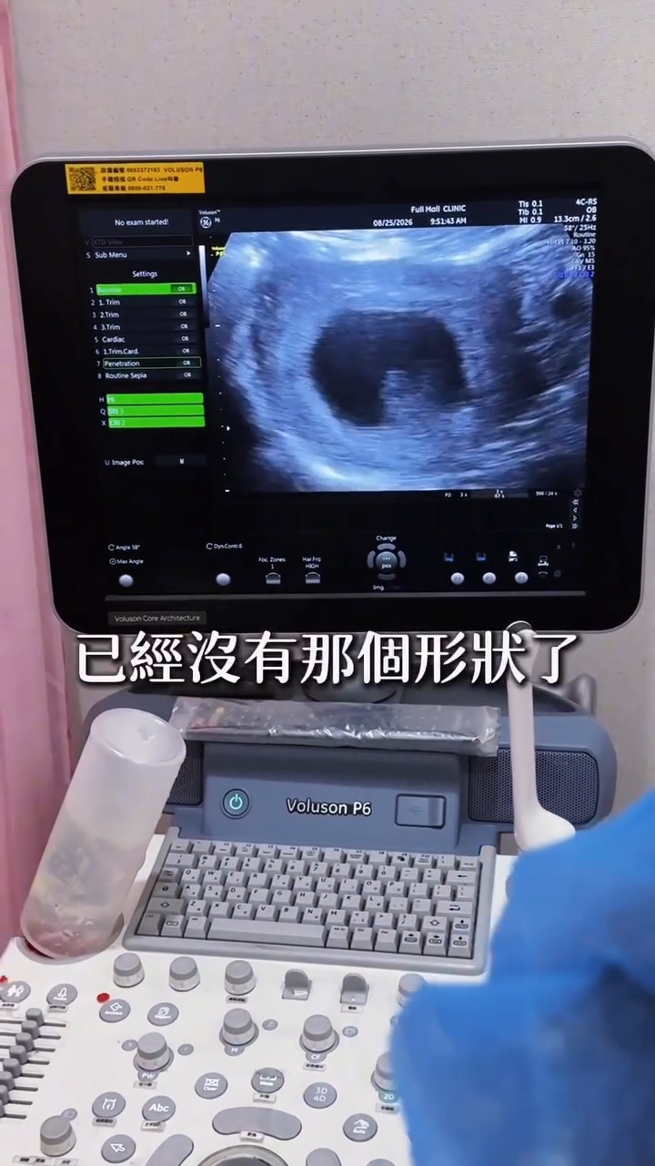 其後再產檢時，連寶寶的形狀也看不清楚了。