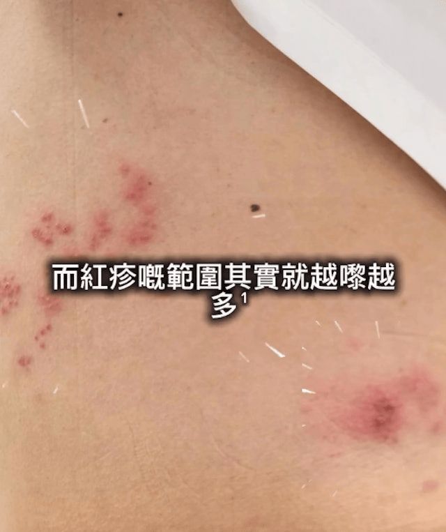 許廷鏗形容帶狀疱疹的痛楚有如突如其來的針刺。