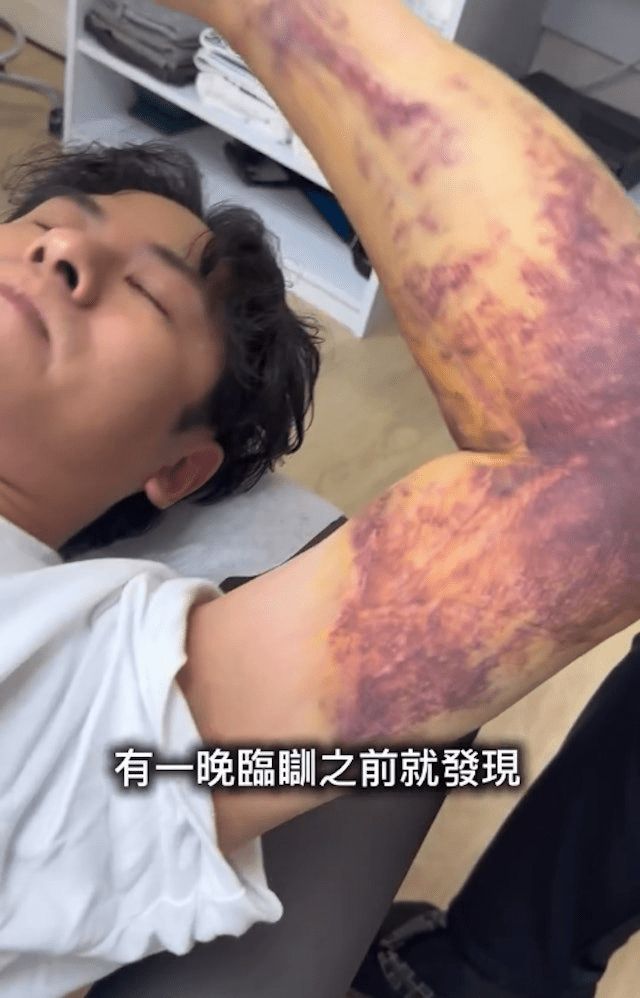 許廷鏗分享左手手術後的瘀傷，以及腰間因帶狀疱疹出現的紅疹。