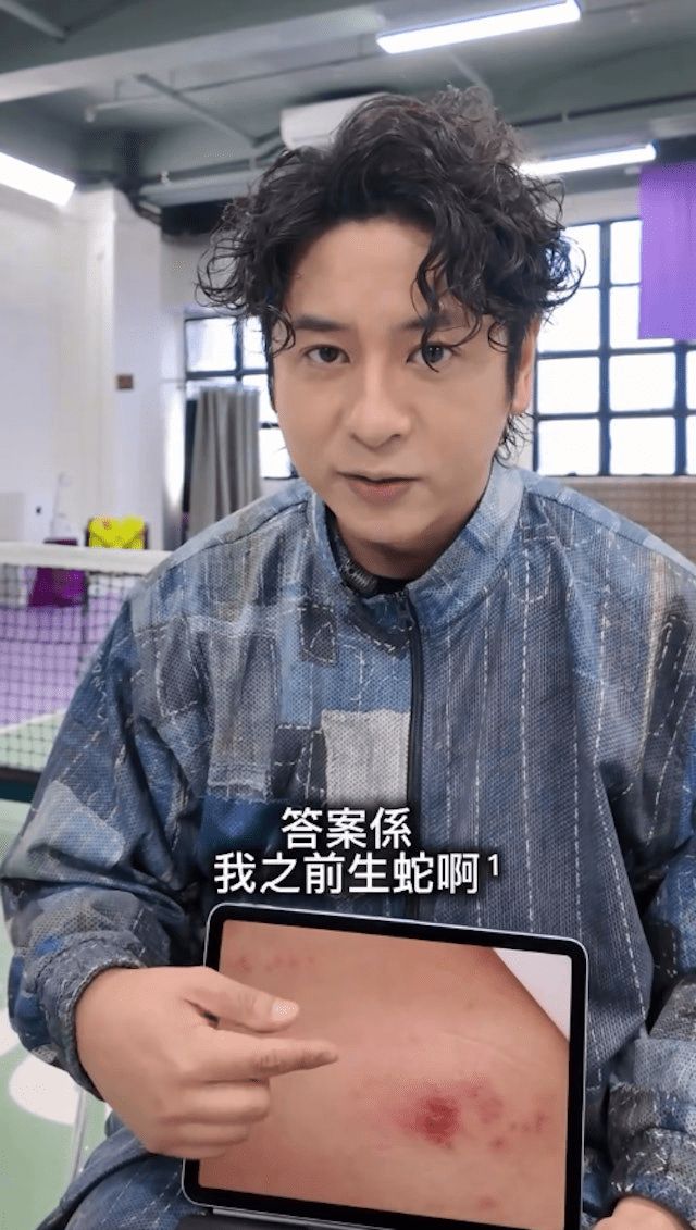 許廷鏗早前曾患上帶狀疱疹（生蛇）。