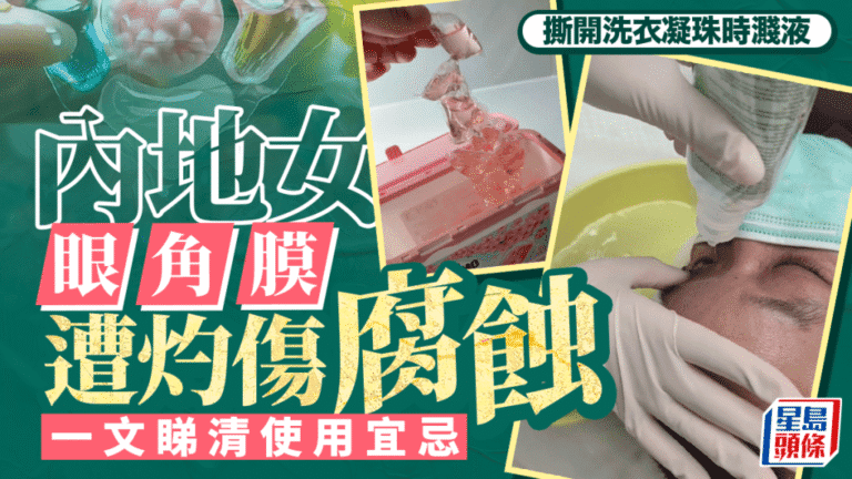 洗衣凝珠使用不當可致眼角膜灼傷 專家詳解安全使用要點