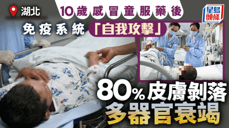 湖北男童服感冒藥後出現嚴重藥物過敏 八成皮膚受損