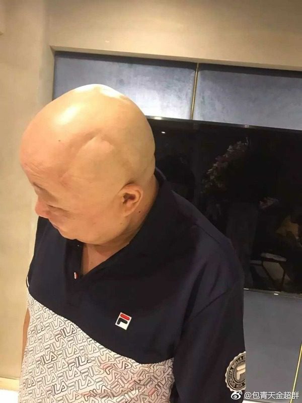 當時金超群表示自己已經康復。
