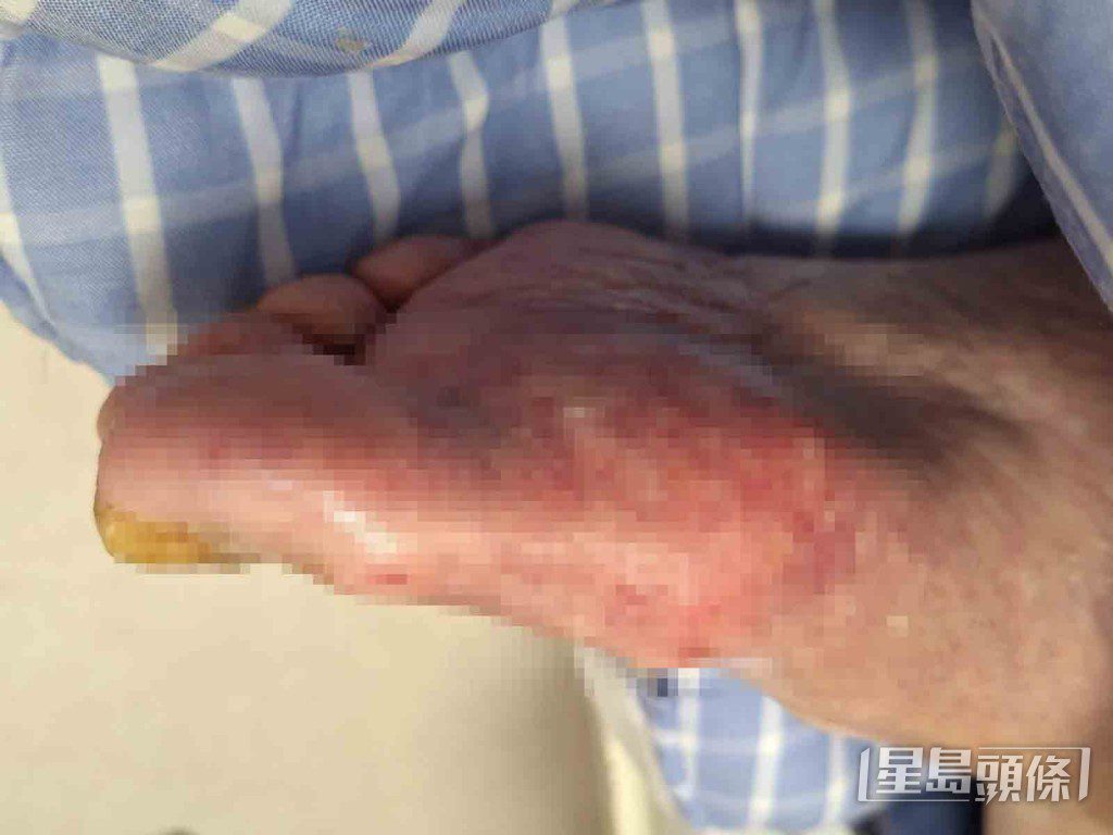方俊日前從外地回港後到護老院探望張偉文,發現其雙腳紅腫、瘀黑且皮膚潰爛。