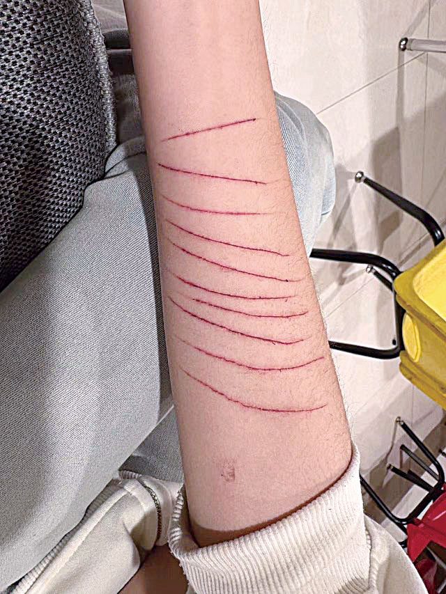莉莉手臂上留有多道傷痕。 母親提供